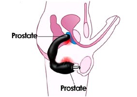 Prostate massage: what is it, how to do, what gives.